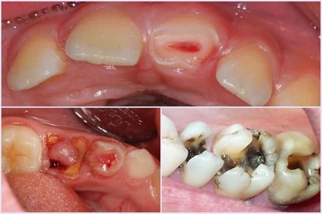 Nguyên nhân và cách xử lý răng sâu lồi thịt không đau