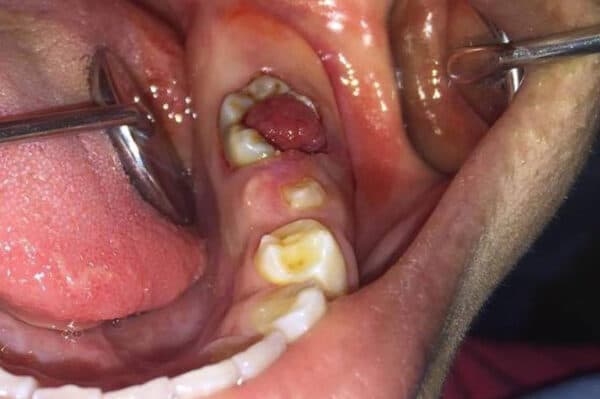 Răng sâu mọc thịt rất đau đớn nên khá dễ nhận biết