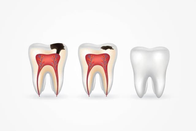 Sự thật về việc sâu răng tự lành được