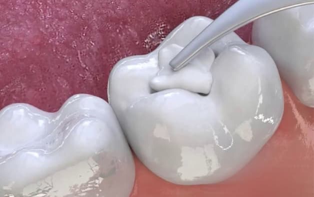 răng số 5 hàm dưới bị sâu