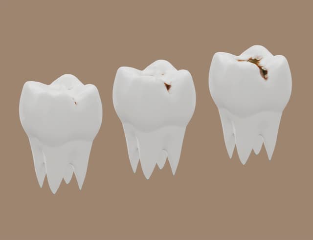 Giải đáp chi tiết: Vì sao lại sâu răng?