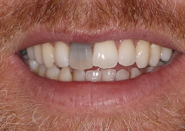 Sâu bên trong răng và cách để điều trị