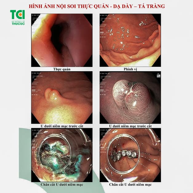 U dưới niêm mạc được loại bỏ nhờ phương pháp cắt hớt niêm mạc EMR. 