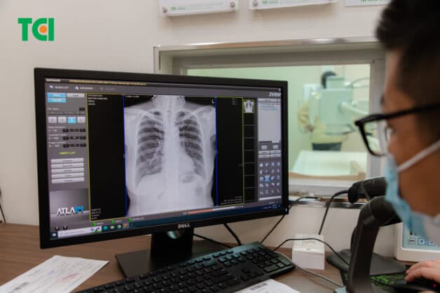 Cần điều trị sớm để ngăn chặn tác hại của bệnh lao phổi