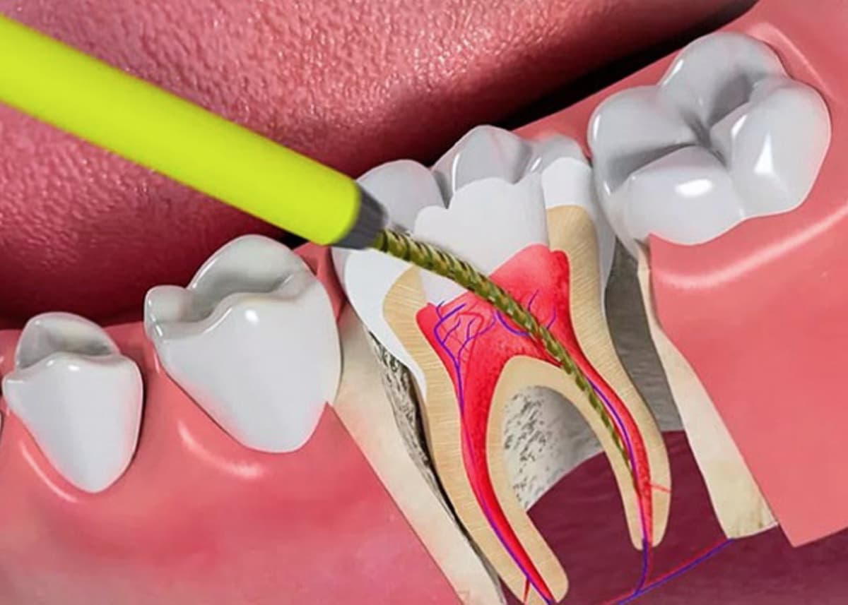 Tại sao sâu răng và phương pháp phòng ngừa