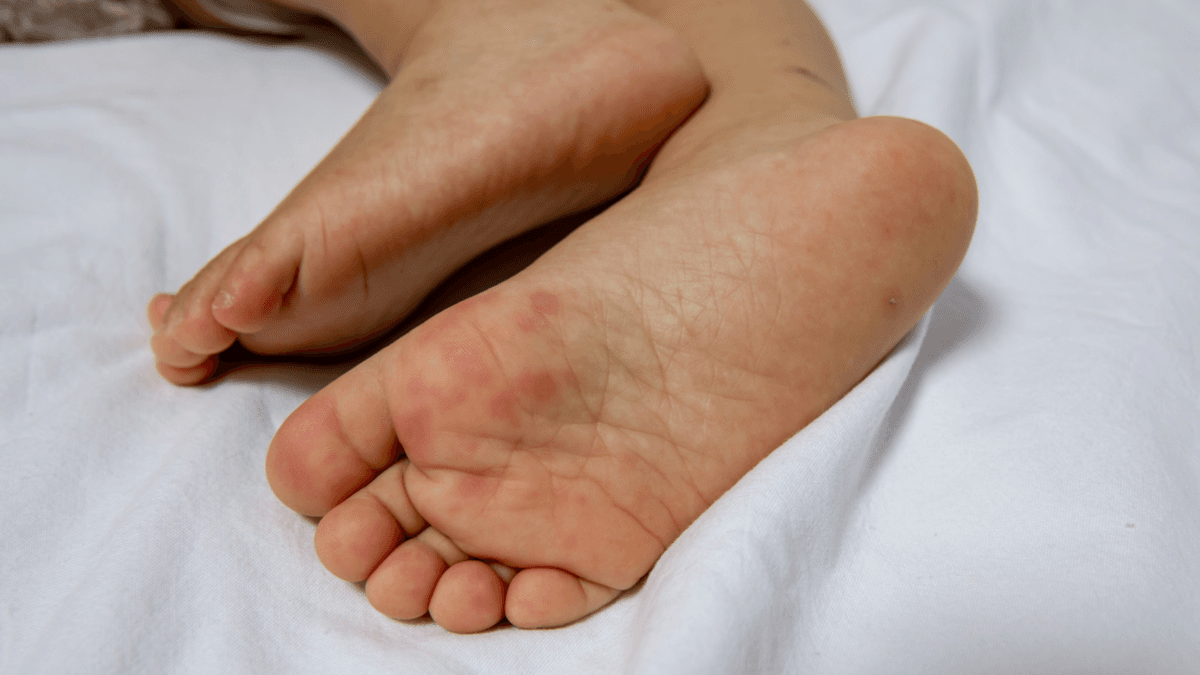 Phân biệt tay chân miệng ở trẻ với sởi