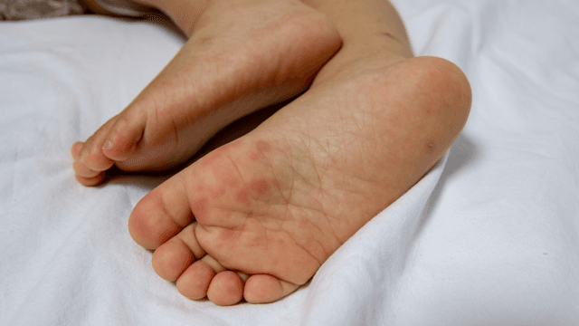 Phân biệt tay chân miệng ở trẻ với sởi