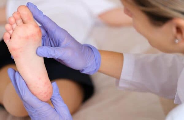 Bệnh tay chân miệng ở trẻ sơ sinh-1