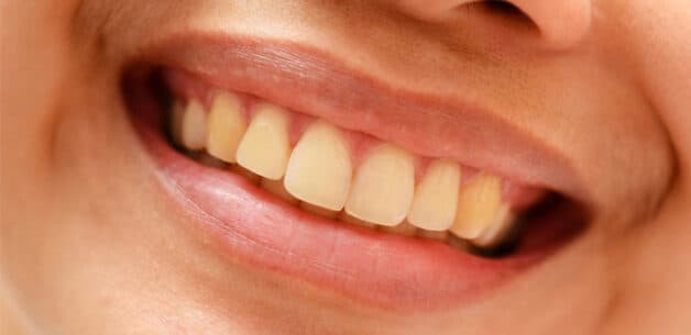 cách tẩy mảng bám trên răng