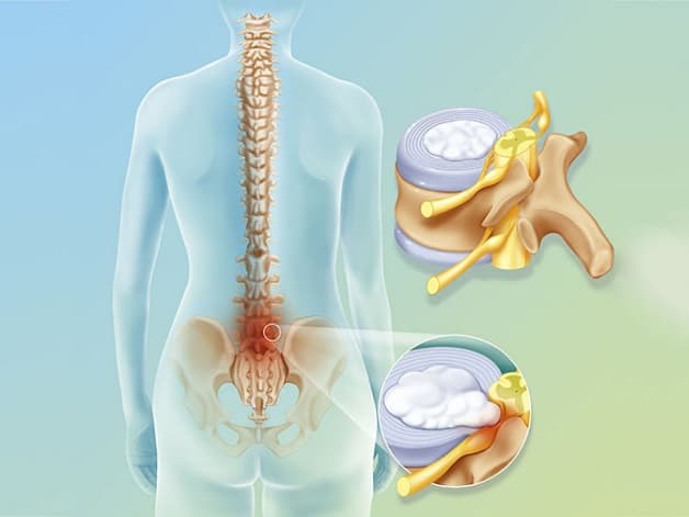 Thoát vị đĩa đệm nên bổ sung gì để cải thiện tình trạng bệnh 