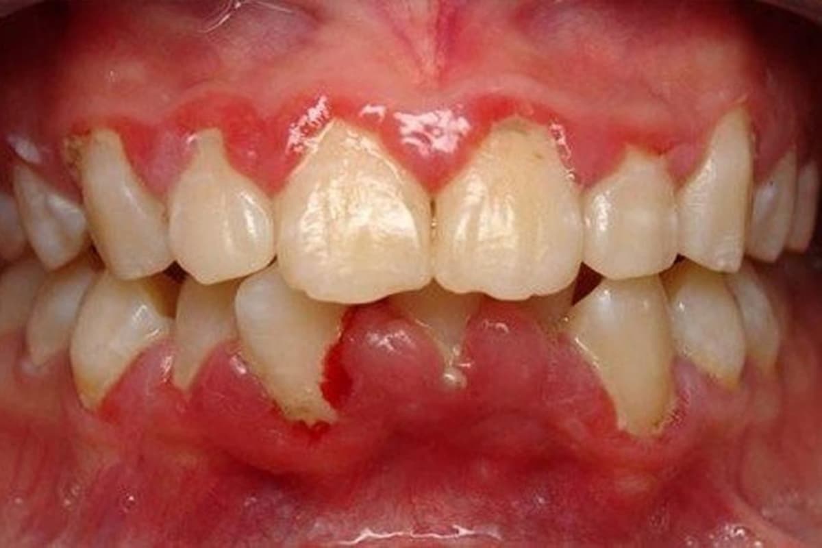 Thuốc bôi trị viêm nướu răng và những điều cần biết