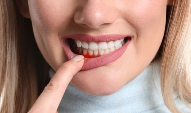 Những loại thuốc bôi viêm nướu răng bác sĩ có thể kê đơn