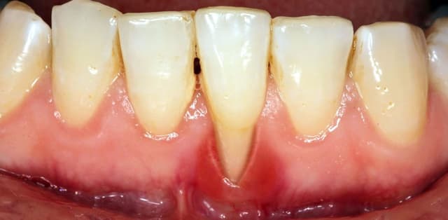 Khám phá các thuốc chữa viêm lợi tụt lợi