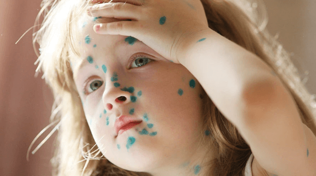 7 Điều cần biết để phòng và điều trị bệnh thủy đậu ở trẻ hiệu quả