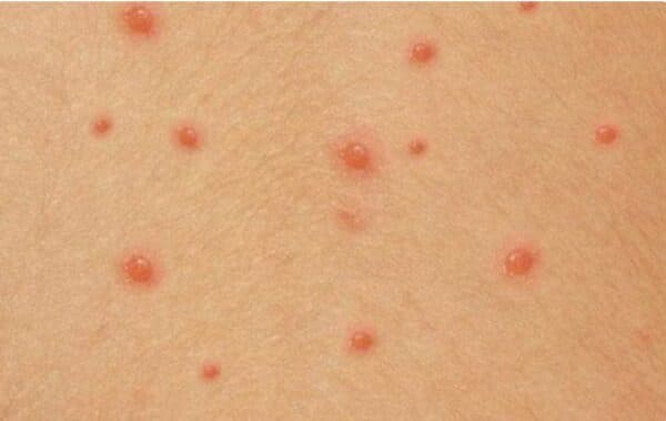 Giải đáp trẻ mắc bệnh thủy đậu khi nào hết lây-2