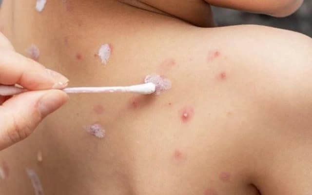 Người mắc bệnh thủy đậu thường sẽ bị phát ban, nổi nhiều mụn nước nhỏ chứa đầy dịch