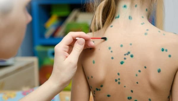 Có thể bôi xanh methylen cho trẻ khi nốt thủy đậu đã vỡ ra