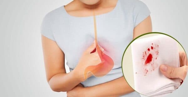 Trào ngược dạ dày khạc ra máu