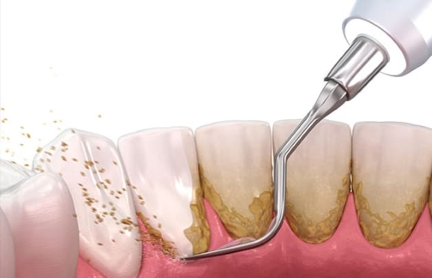 Cạo vôi răng