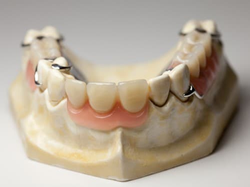 Lựa chọn hàm tháo lắp cho răng cửa