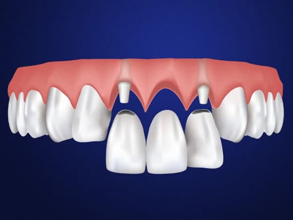 Kỹ thuật bắc cầu răng sứ cho răng cửa