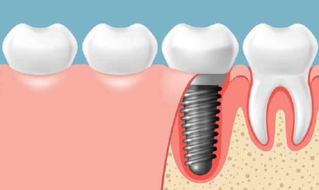 trồng răng Implant giá bao nhiêu
