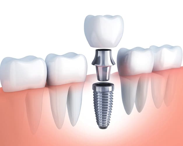 trồng răng Implant