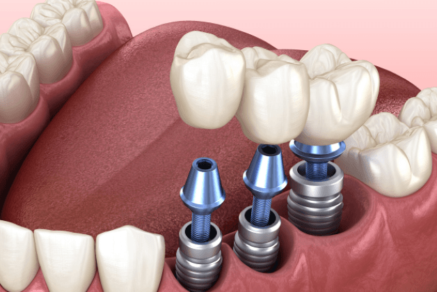 trồng răng Implant bao nhiêu tiền
