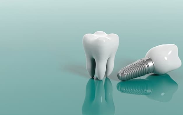 Giá tiền trồng răng implant và các phương pháp thực hiện