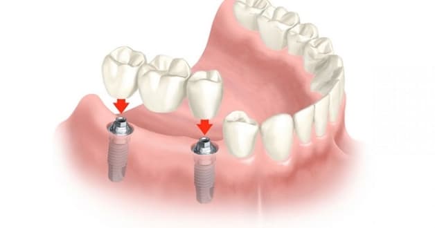 Trồng răng Implant giá bao nhiêu và một số vấn đề liên quan