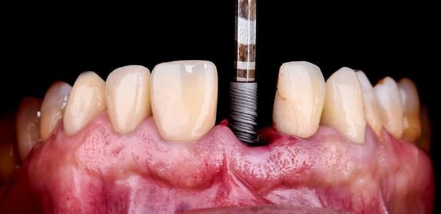 Những nguy cơ từ trồng răng Implant giá rẻ