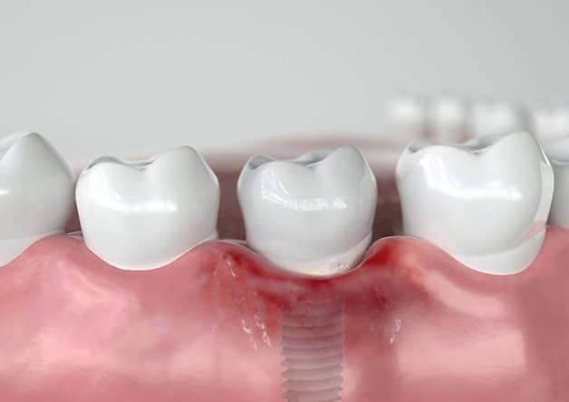trồng răng Implant giá rẻ nhiều nguy cơ