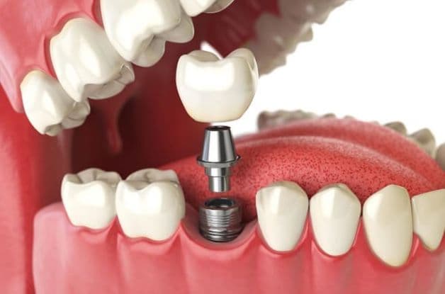 Có nên trồng răng implant giá rẻ nhất không