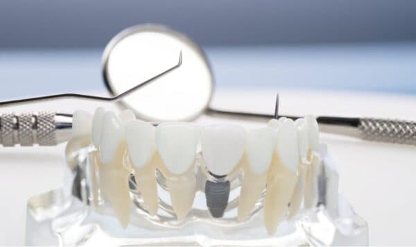 Lựa chọn trồng răng implant trả góp: Có nên hay không?