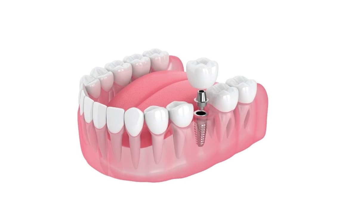 Những tiêu chí cho địa chỉ cấy ghép răng implant uy tín