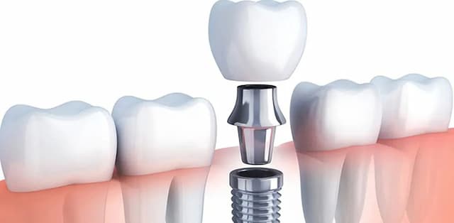 Tìm lời giải đáp thắc mắc: Trồng răng sứ giá bao nhiêu