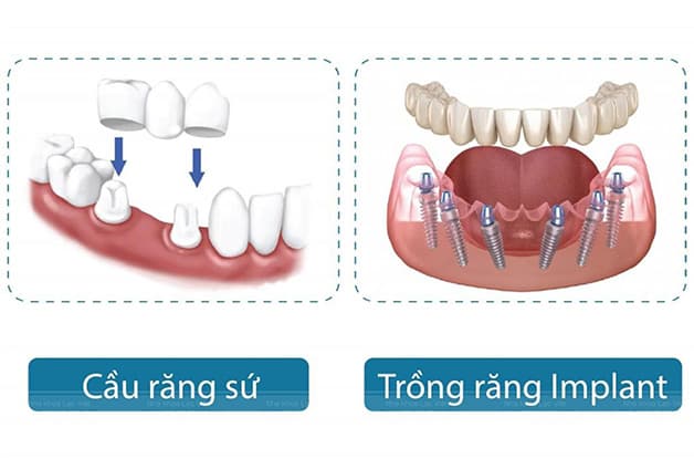Thắc mắc Trồng răng sứ giá bao nhiêu