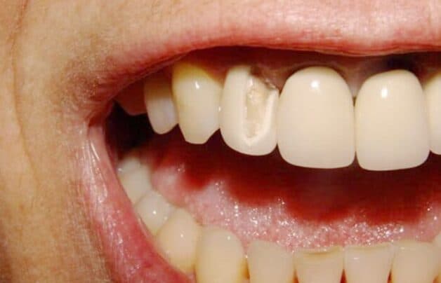 hệ lụy trồng răng sứ giá rẻ