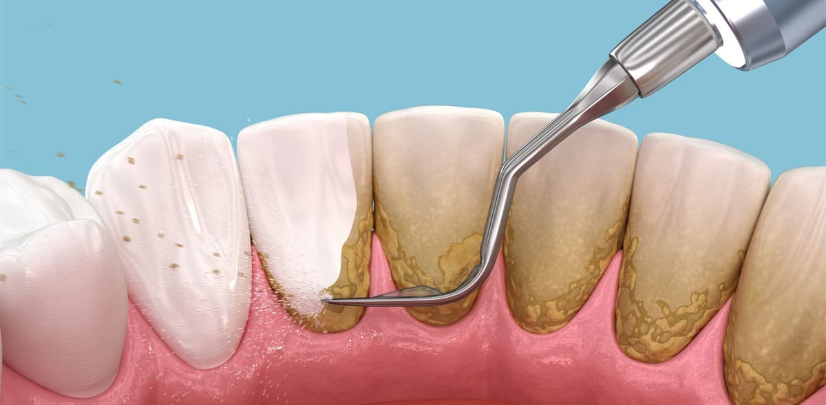 Tự lấy cao răng – Những điều nên biết
