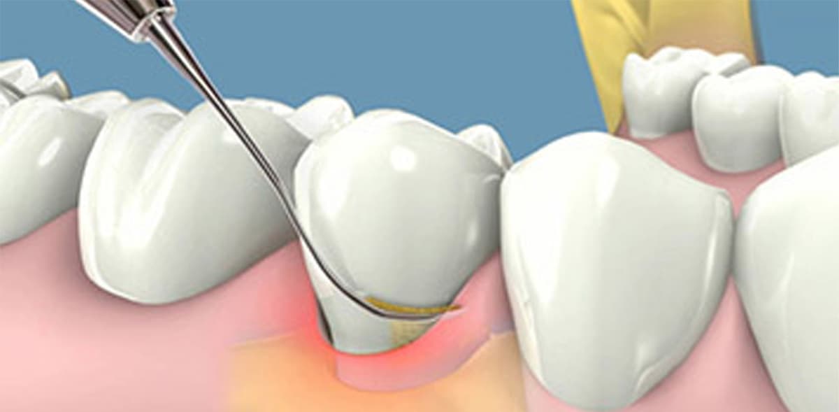 Đánh giá hiệu quả của các hình thức tự lấy cao răng tại nhà