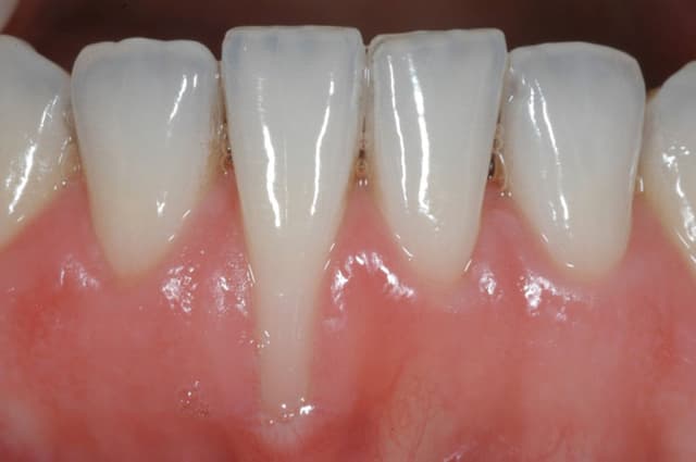 Tìm hiểu về tình trạng tụt lợi răng lung lay