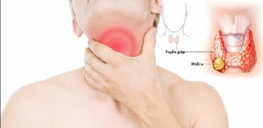 Tuyến giáp có nhân: nguyên nhân hình thành và triệu chứng