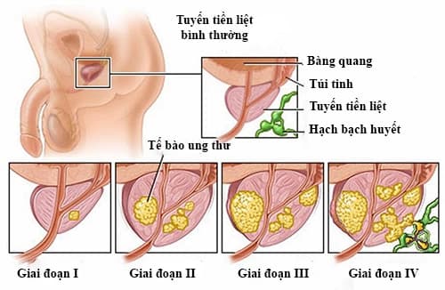Tìm hiểu về ung thư tuyến tiền liệt giai đoạn đầu