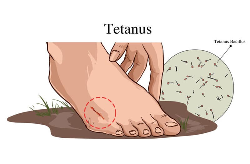 Bệnh uốn ván là một loại bệnh nhiễm trùng cấp tính gây ra bởi vi khuẩn Clostridium tetani