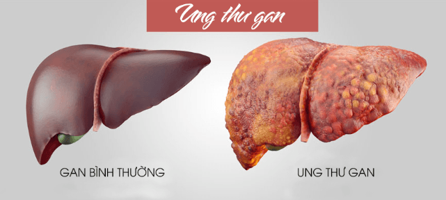 Viêm gan A và viêm gan B có thể dẫn đúng ung thư gan và tử vong