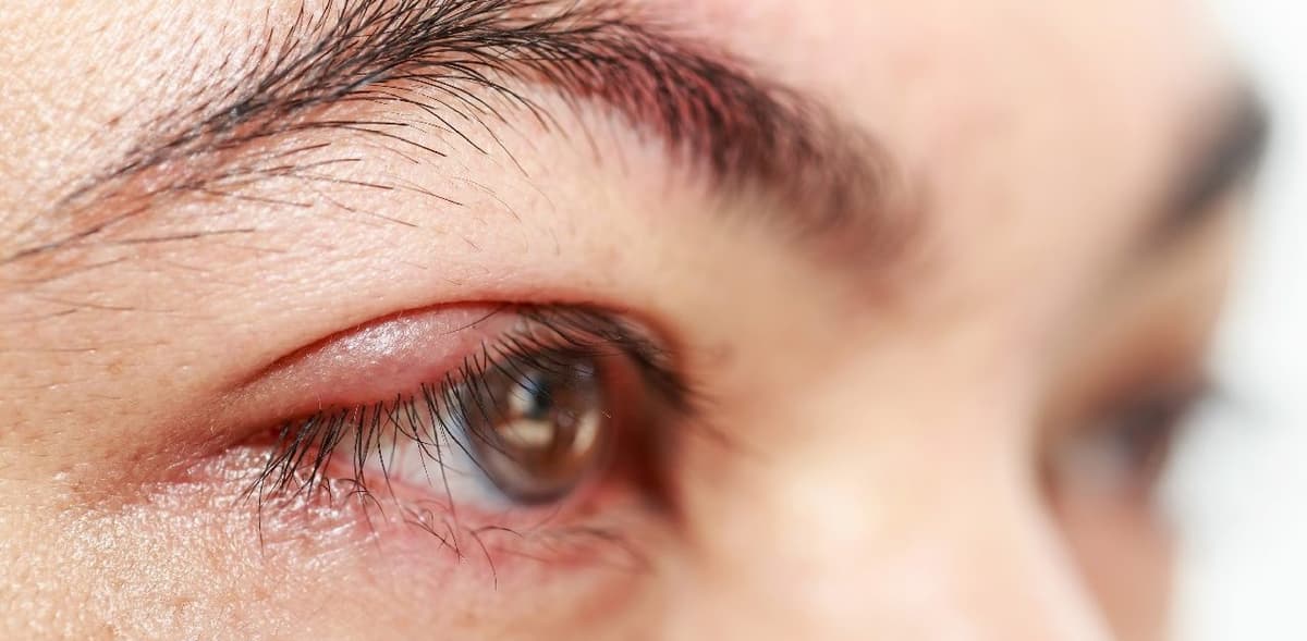 Viêm bờ mi icd 10 – Nhận biết, phân loại và cách điều trị