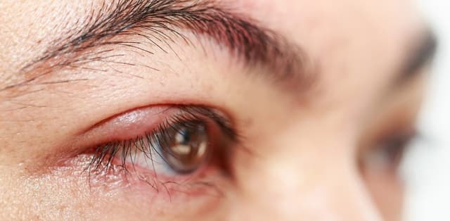 Viêm bờ mi icd 10 – Nhận biết, phân loại và cách điều trị