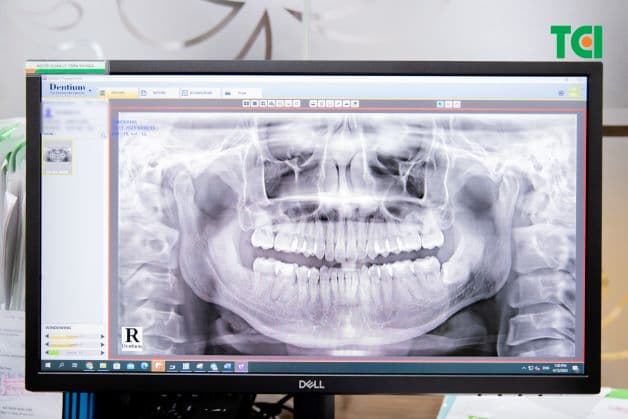 Trong trường hợp bị tụt lợi, cần đi thăm khám bác sĩ để được điều trị sớm