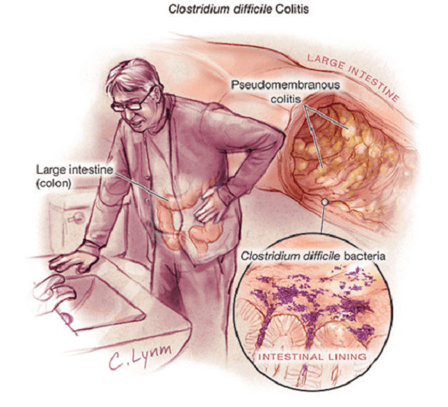 Nguyên nhân viêm đại tràng màng giả là gì