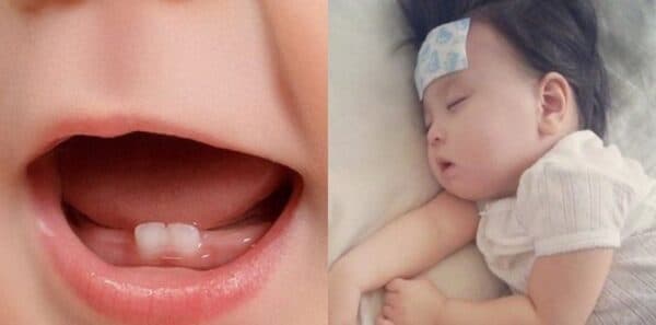 viêm lợi gây sốt có nguy hiểm